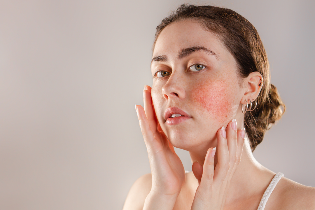 Hydrocortisone for Rosacea: Can it Help Reduce Redness and Inflammation?