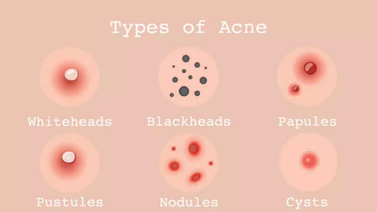 Nodular Acne vs. Cystic Acne: What's the Difference?
